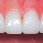 Photos of installed veneers