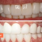 Photos of veneers and lumineers on teeth