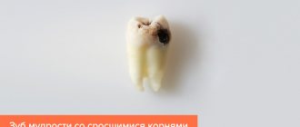 Photo of a wisdom tooth with fused roots