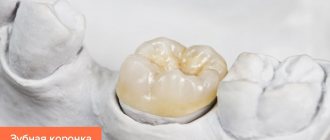 Photo of a dental crown