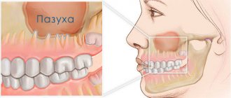 maxillary sinuses