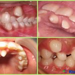 Hyperdentia - abnormal number of teeth