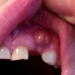 Abscess on the upper gum of a child