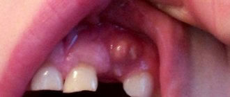 Abscess on the upper gum of a child