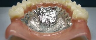 Boundaries of the base of a removable plate denture