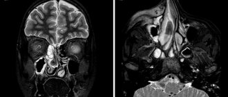 Fungal sinusitis on an MRI image