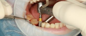 Implants Implantium - Dentistry Line Smiles