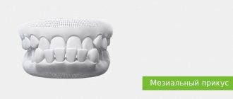 correction of mesial bite