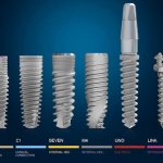 Israeli MiS implants