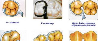 How do Ney system clasps work?