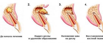 How to remove formation