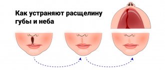 Как устраняют расщелину губы и неба