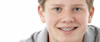 How to choose the color of braces