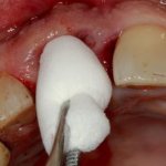 What medicine is put into the hole after tooth extraction?