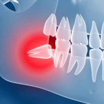 Figure 8 hood - Smile Line Dentistry