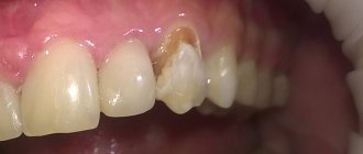 Caries on teeth