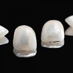 ceramic veneers