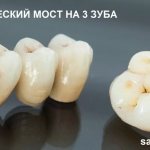 Керамический зубной мост