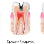 Classification of dental caries