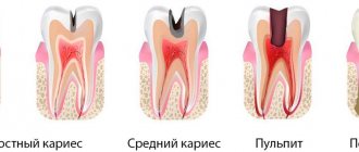 Classification of dental caries