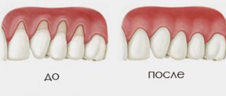 Gum coagulation before and after.jpg