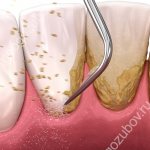 When is oral scaling performed?