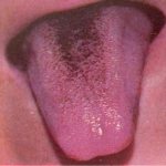 Brown coating on the tongue in teenagers