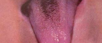 Brown coating on the tongue in teenagers