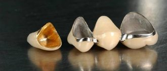 metal-ceramic crowns