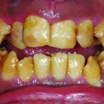 Cosmetic enamel restorations: natural biomimetic layering technique