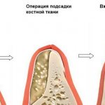 Костная пластика