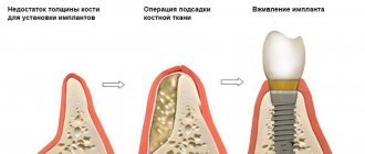 Bone grafting