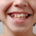 Child&#39;s teeth are crooked