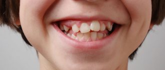 Child&#39;s teeth are crooked