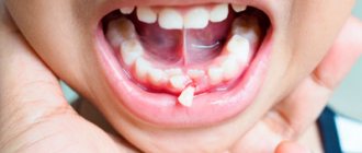 Bleeding of the affected gums - Dentistry &quot;Line of Smile&quot;