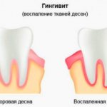 Treatment of childhood gingivitis in Rostov-on-Don