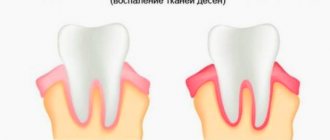 Treatment of childhood gingivitis in Rostov-on-Don