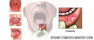 Лечение стоматита вифероном