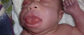 Macroglossia of the tongue in a child