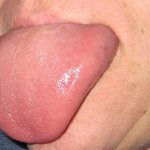 macroglossia of the tongue