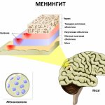 Meningitis.jpg