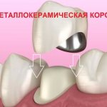 Metal-ceramic crowns - a successful combination of strength, cost and beauty