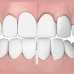 methods for determining correct bite