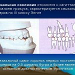 Mesial bite