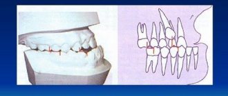 Mesial bite