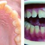 Microdental prosthetics in Moscow