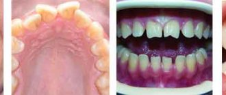 Microdental prosthetics in Moscow