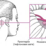 Microvascular decompression