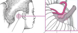 Microvascular decompression