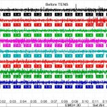 resting myography before treatment shows an imbalance in muscle function